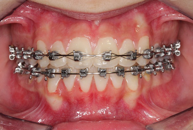 Material Zahnspange: Alles zu Vor- & Nachteilen